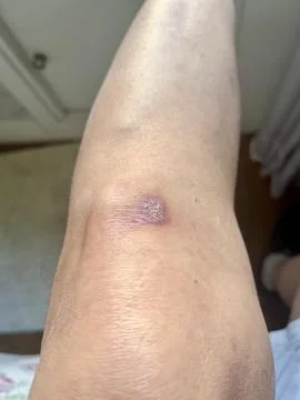 Scar in knee Stock Photos