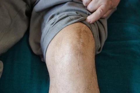 Scar on the knee from a prosthesis Foto stock