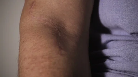 Scar on the man's hand close-Up Vidéo 100890275