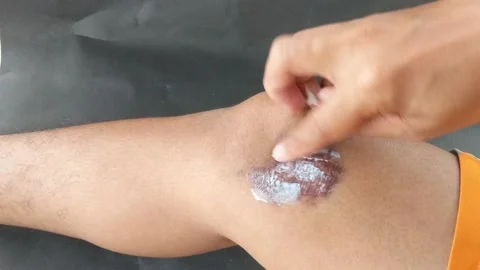 A scar on a man's leg Stock Footage 220120379