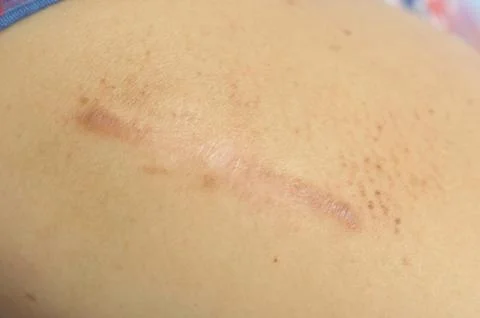 Scar - a permanent effect on someones mind. Stock Photos
