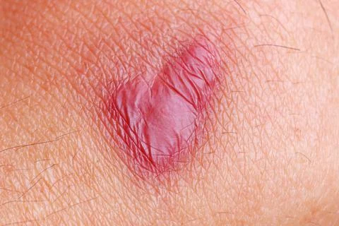 Scar on skin for pattern Stock Photos