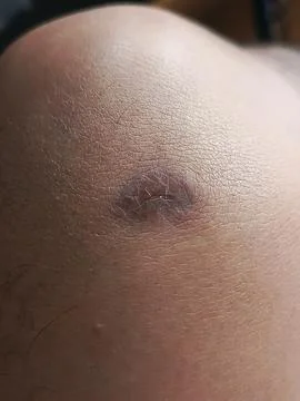 Scar on the skin Stock Photos