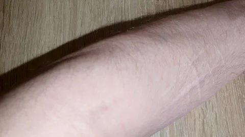 Scars from cuts on the arm. Old traces of a skin cut on the forearm. Stock Footage 267555328