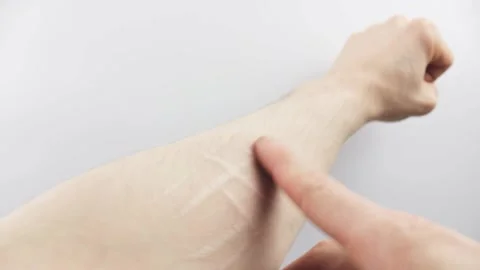 Scars from cuts on the arm. suicide.Cut marks on arms. Stock Footage 202390767