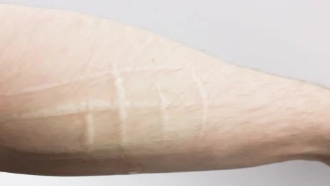 Scars from cuts on the arm. suicide.Cut marks on arms. Stock Footage 202390811