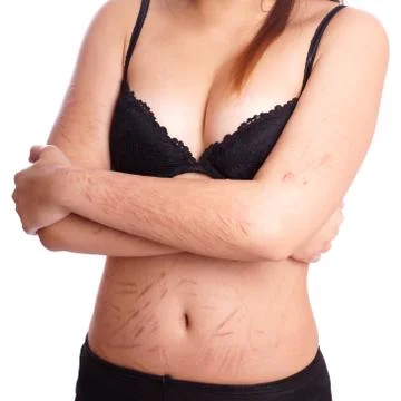 Scars from deliberate self-harm Stock Photos