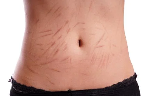 Scars from deliberate self-harm Stock Photos