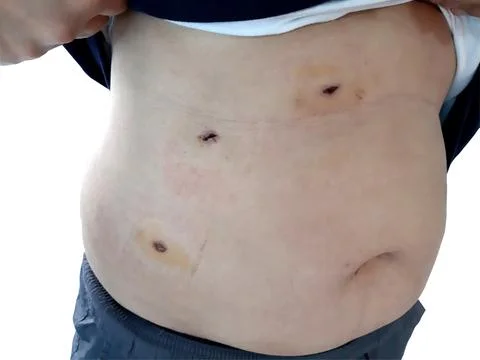 Scars from gallbladder surgery Stock Photos