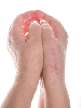 Scars on hands Stock Photos