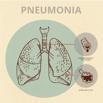 A schematic illustration of the human body with an infographic of the symptoms Illustrazione stock