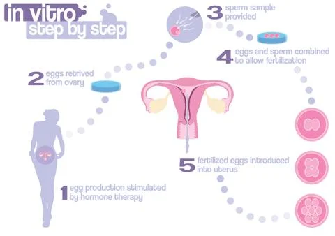 Scheme of in vitro fertilization - step by step Stock Illustration
