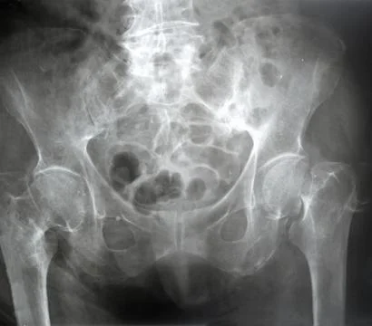 Schmorl's nodes Stock Photos