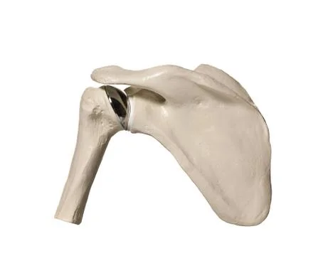 Schoulder replacement Stock Illustration