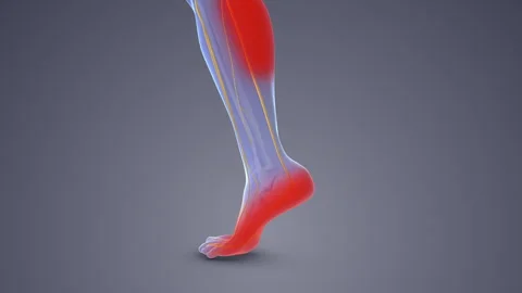 Sciatic Nerve Compression Affecting Blood Flow Circulation Stock-Footage 285822102