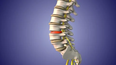 Sciatic nerve pain due to herniated disc Stock Illustration