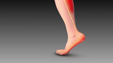 Sciatic Nerve Pain Leading to Circulation Issues Stock Footage 284110430