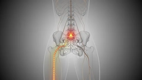 Sciatica causes lower back and leg pain Vídeos de archivo 284437401