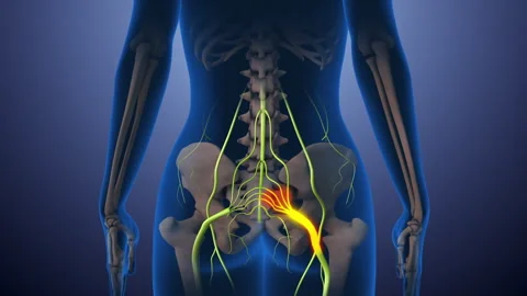 Sciatica nerve pain lower back through hips to leg Stock Footage 276164778