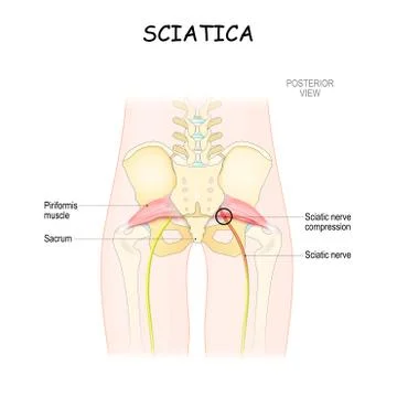Sciatica. piriformis syndrome Illustration