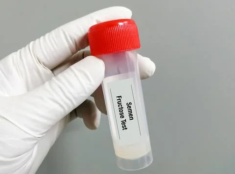 Scientist hold sample container with semen for Semen fructose test. 스톡 사진