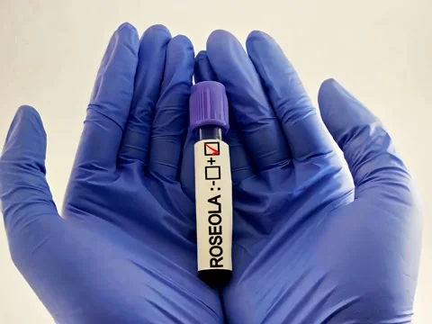 Scientist holding blood samples for  Roseola (Exanthem subitum) test. Stock Footage 299831366