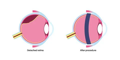 Scleral buckle procedure Stock Illustration