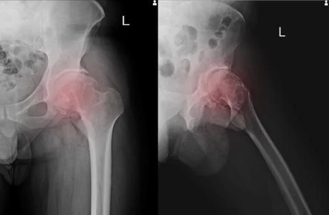 Sclerosis of articular surface of acetabular with marginal osteophytes. Osteo Stock Photos