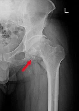 Sclerosis of articular surface of acetabular with marginal osteophytes. Osteo Stock Photos