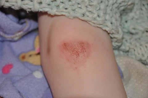 Scraped Knee Stock Photos