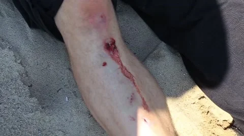 Scraped Shin Stock Footage 56661162