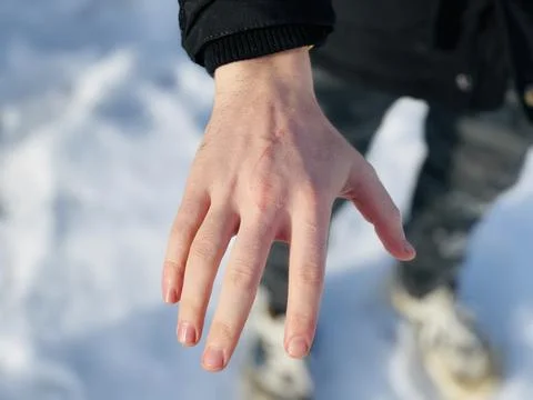 Scratch on a hand, close up Foto stock