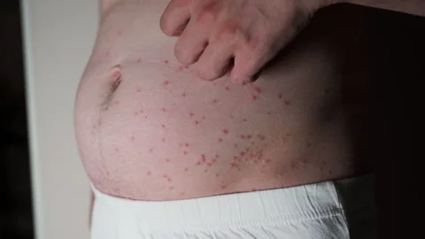 Scratch Itchy Red Bumps On The Skin From Bugs Bites On Stomach. Allergic Video stock 244697974