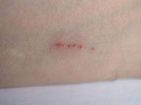 Scratch scar on arm Stock-Fotos