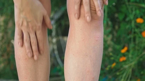 Scratch soft itchy red bumps on the skin from mosquito bites on leg with hand Stock Footage 95559171
