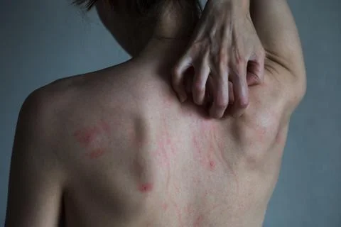 Scratches on a back. Foto stock