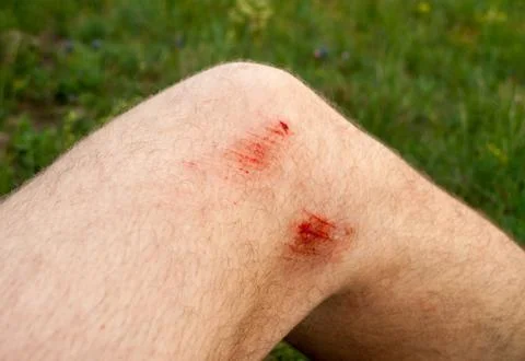 Scratches on the knee Stock Photos