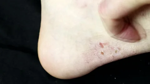 Scratching A Patch Of Eczema On The Ankle Area 스톡 동영상 136120483