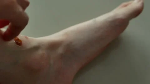 Scratching a patch of eczema on the leg Stockbeeldmateriaal 143009126