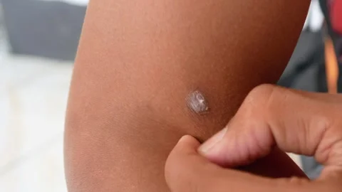 Scratching the wound on the hand of a brown skinned Asian man Stock Footage 310639019