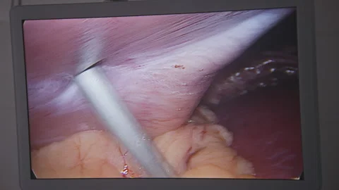 Screen with displayed view from laparoscopic camera during surgery Stock Footage 252722614