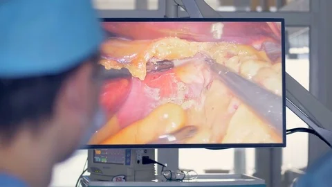 A screen with laparoscopy surgery and manipulation of soft tissues. Stock Footage 84089337