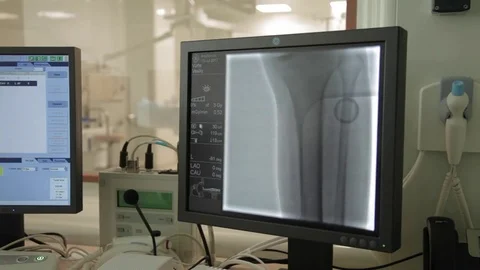 Screen with manipulations at angiographic operation room  Stock Footage 81323017