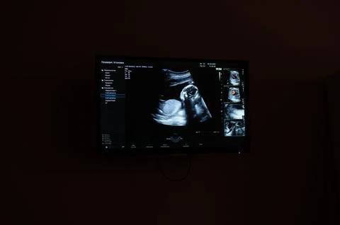Screen shot of a second trimester prenatal screening. Stock Photos
