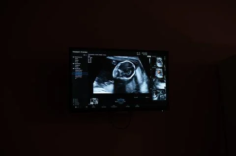 Screen shot of a second trimester prenatal screening. Stock Photos