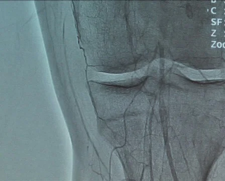 Screen Showing Cardiac Angiogram Stock Footage 40414662