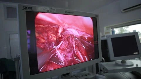 Screen showing endoscopic surgery Stock Footage 62389024