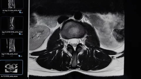 On the screen transverse or axial plane MRI of the lumbar spine showing detailed Stock-Footage 328286984