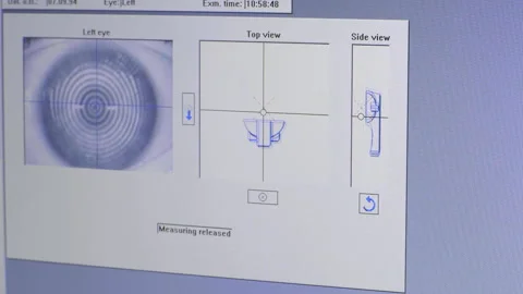 Screen view digital biometrics and tomography of the eye during medical Stock Footage 155483939