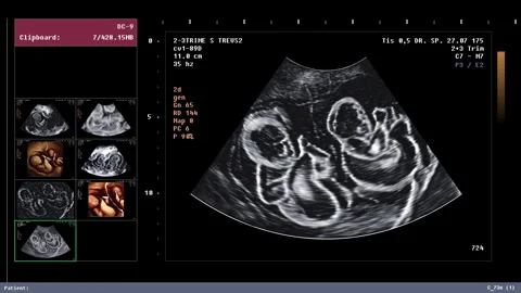 Screening diagnostic tech found two identical children in the woman belly Video stock 270227711